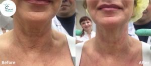 تاثیر دستگاه پلاژن تراپی سه هندپیس Geneo+ بر روی پوست