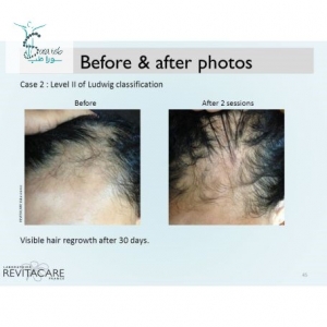 بهترین کوکتل ریزش مو