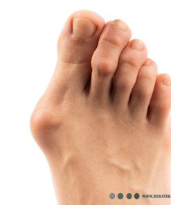 اصلاح کننده هالوکس والگوس پا