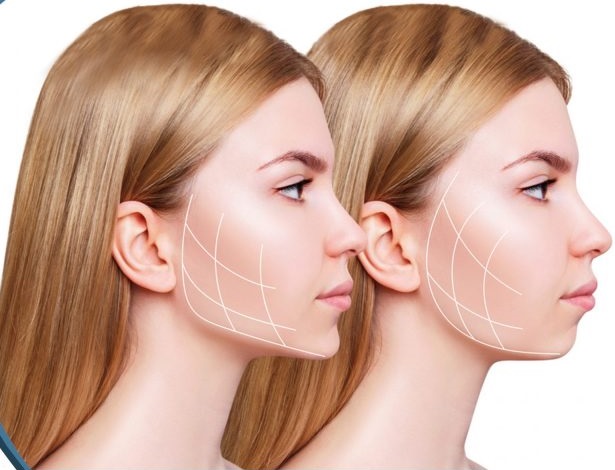 تاثیر ژل رووفیل بر زاویه سازی و فرم دهی صورت