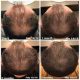 کوکتل رشد مو فیوژن F-HAIR | تقویت‌کننده فولیکول و رطوبت‌رسان قوی