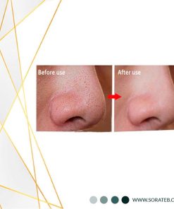 چسب جوش سرسیاه بینی ویونسا