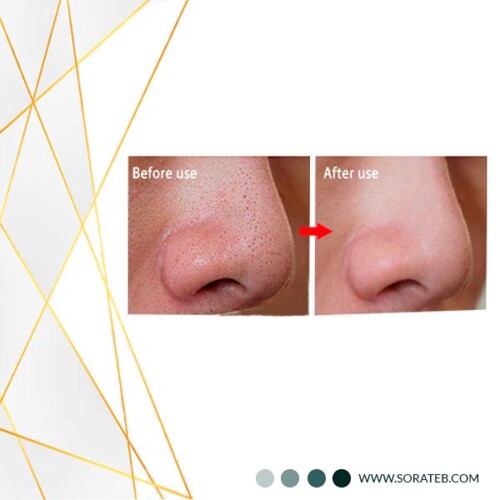 چسب جوش سرسیاه بینی ویونسا