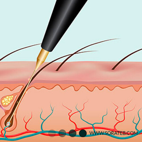 دستگاه الکترولایزر استارمکس بیوتی