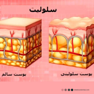 لوسیون گرم لاغری رفع سلولیت 250 میلی سامی استایلیش