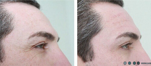 مزوکوکتل لیفت صورت فیوژن 