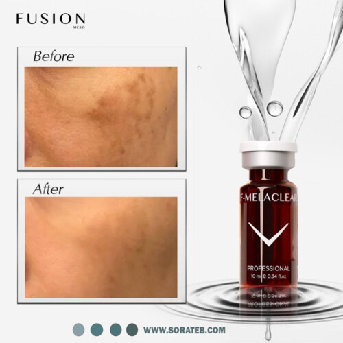 مزوکوکتل رفع لکه فیوژن