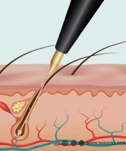 سوزن الکترولیز مدل k4 برند باله BALLET