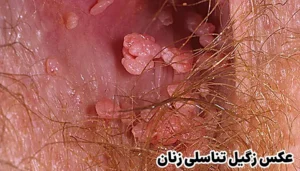 مکمل زگیل تناسلی 