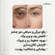 ژل کربوکسی زیر چشم ناچورهکس | کاهش تیرگی و پف دور چشم